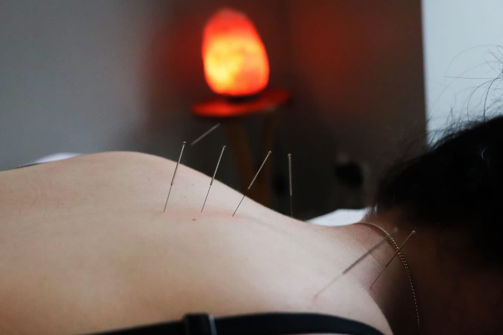 Dry Needling